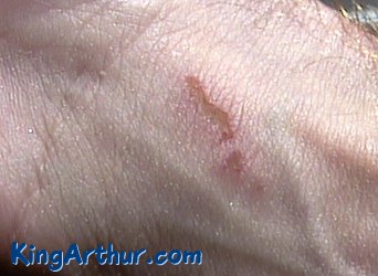 A Sore Wound